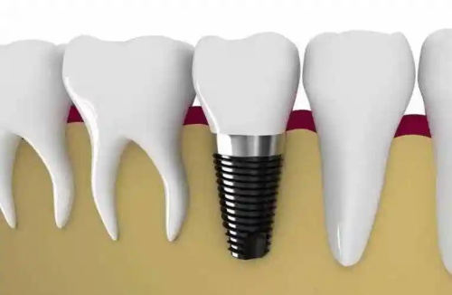 常見的義齒有哪些(圖4) 常見的義齒有哪些(圖4)