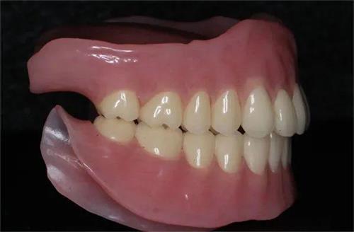 常見的義齒有哪些(圖3) 常見的義齒有哪些(圖3)