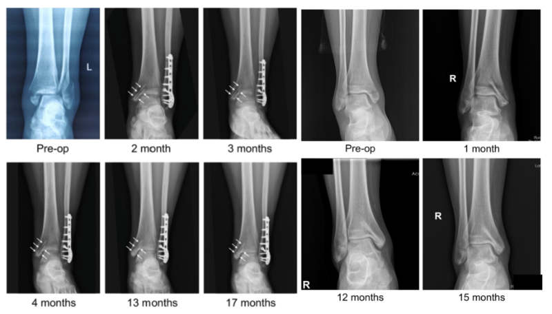 醫用鎂合金骨內植物臨床試驗研究突破性進展(圖2)
